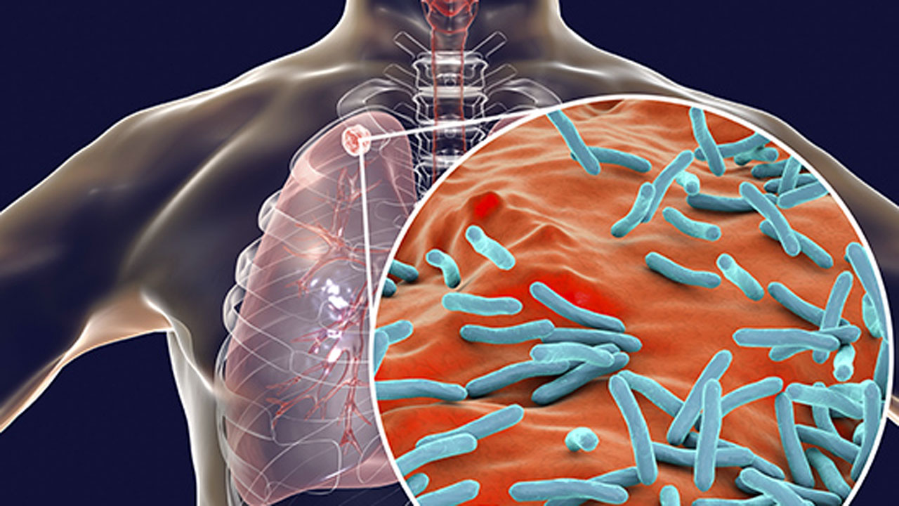 World Tuberculosis Day | ఇంత‌కీ క్ష‌య వ్యాధి ఎందుకు వ‌స్తుంది? దాని ల‌క్ష‌ణాలు ఏంటి? చికిత్స ఎలా?
