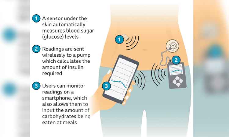 ఇన్సులిన్‌ అవసరాన్ని ఇట్టే చెప్పేస్తుంది!