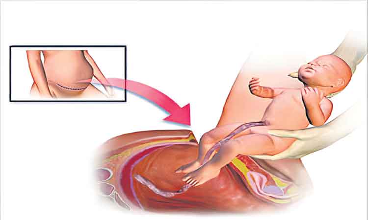 సిజేరియన్‌ ప్రసవాలపై ఆడిట్‌!