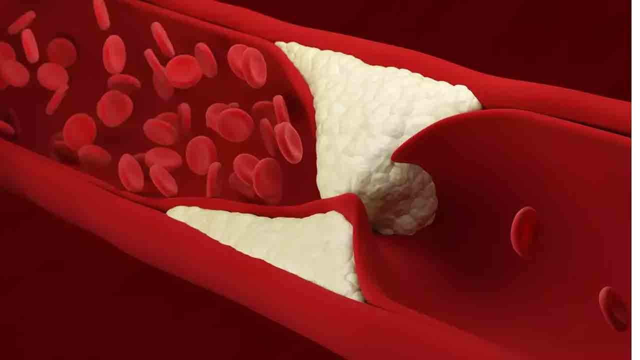 Health Tips | జీవ‌న శైలి మార్పుల‌తో అధిక కొలెస్ట్రాల్‌, గుండె జ‌బ్బుల‌కు చెక్‌!