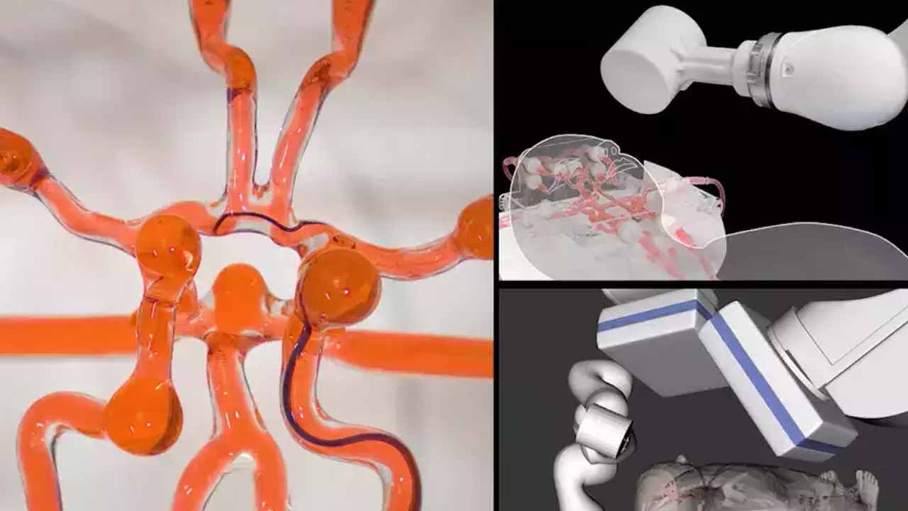 బ్రెయిన్ స్ట్రోక్‌కు గురైన వ్య‌క్తికి ఉన్న‌చోటే రోబోటిక్‌ చికిత్స‌.. అమెరికా ప‌రిశోధ‌కుల స‌రికొత్త ఆవిష్క‌ర‌ణ‌