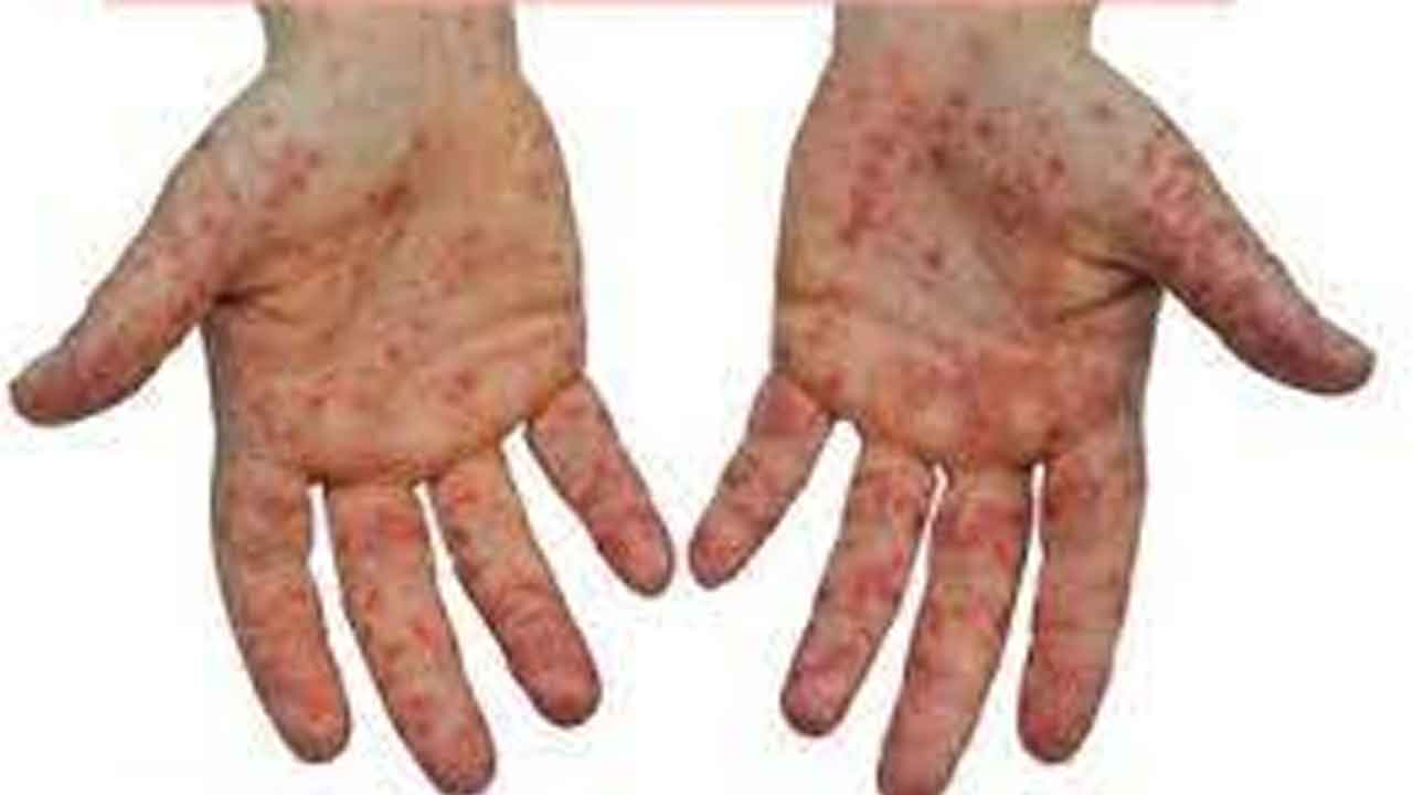 థయామిన్ లోపం వల్ల కలిగే వ్యాధి ఏది?