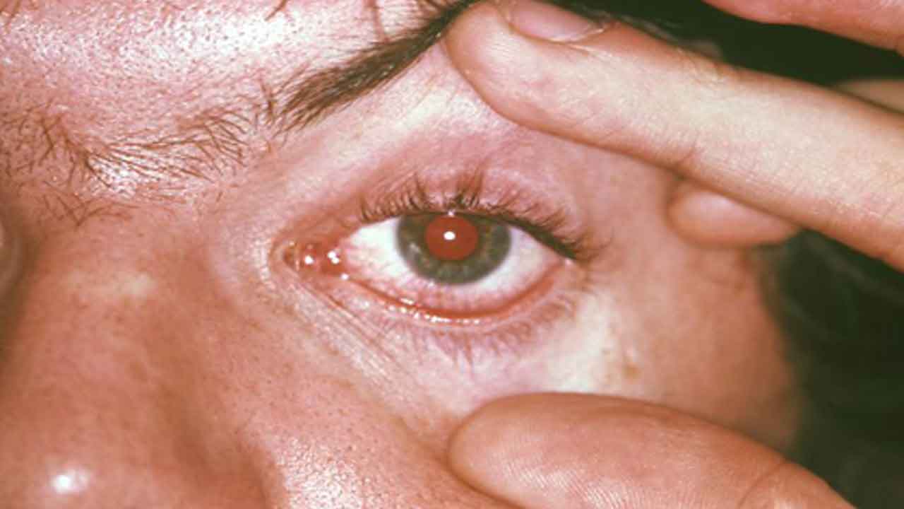 ట్రకోమా అనేది ఏ భాగానికి సోకుతుంది?