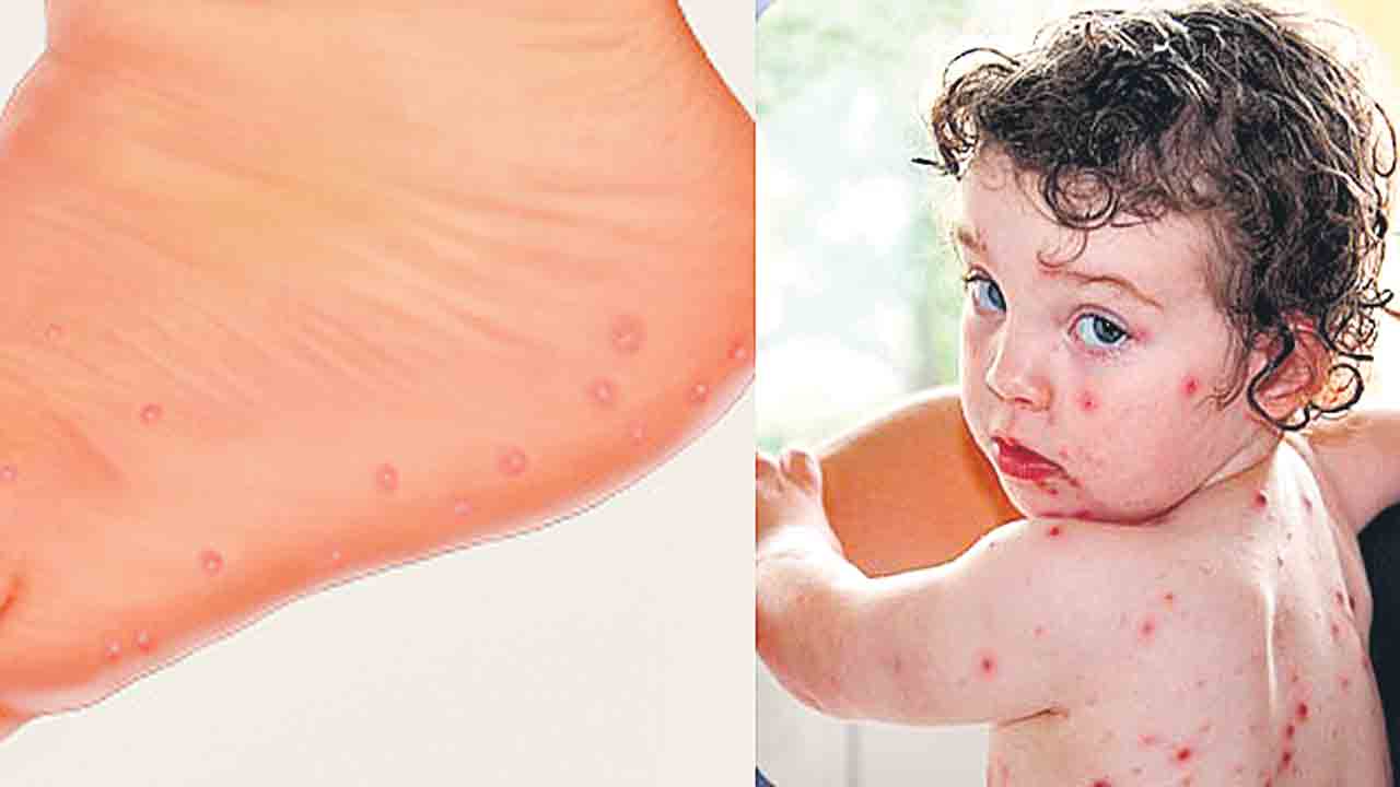 tomato flu | కేర‌ళ‌లో ఐదేండ్ల‌లోపు పిల్ల‌ల‌ను వెంటాడుతున్న‌ కొత్త వైర‌స్‌.. దీని ల‌క్ష‌ణాలు ఏంటంటే..