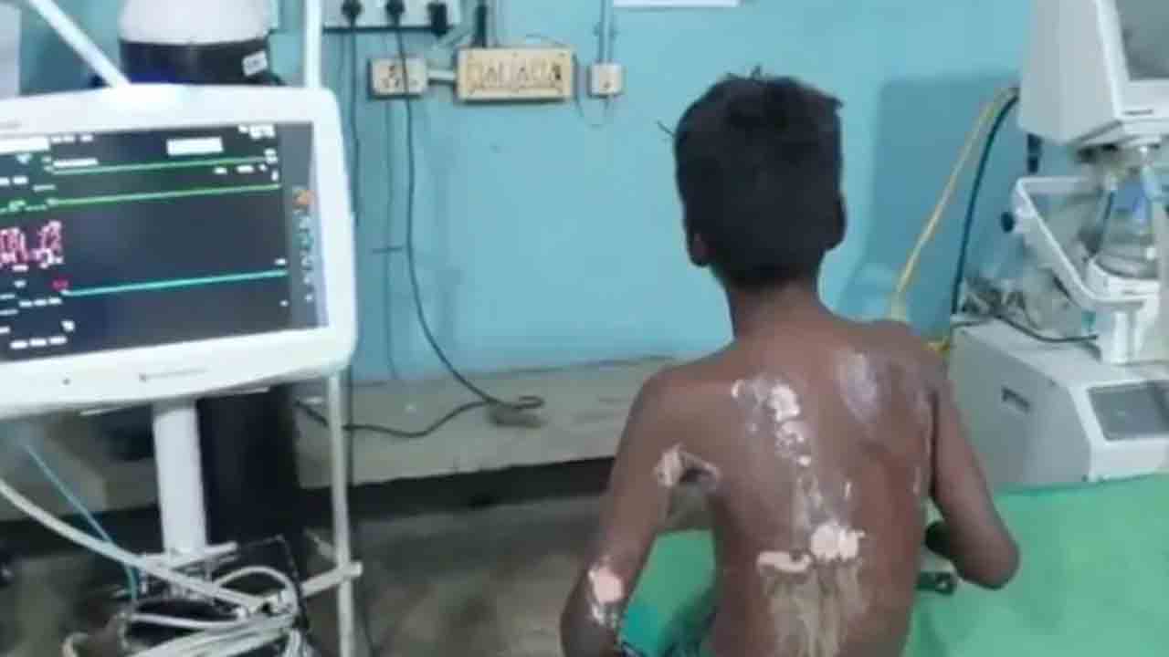 విద్యార్థిని కులం పేరుతో దూషించి… మంటల్లోకి తోసేసిన విద్యార్థులు