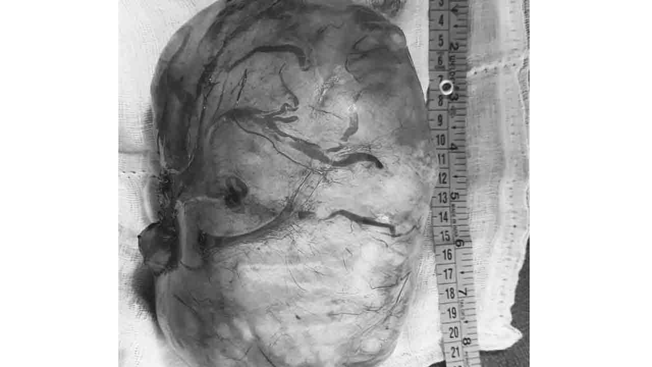 మ‌హిళ గ‌ర్భాశ‌యంలో 3 కిలోల క‌ణితి.. శ‌స్త్ర చికిత్స విజ‌య‌వంతం