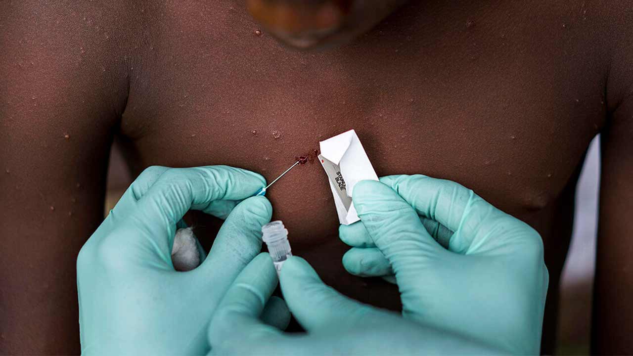 పెరుగుతున్న మంకీపాక్స్‌ ముప్పు.. వెయ్యిపైగా కేసులు రికార్డు..!