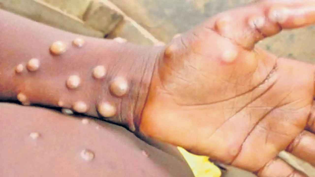 మహమ్మారిగా మంకీపాక్స్‌