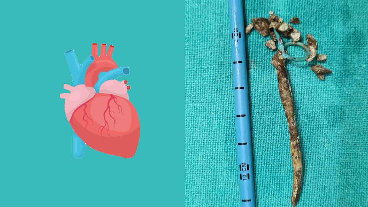 గుండె వెనుక కిడ్నీ.. ప్రాణం కాపాడిన నిమ్స్‌