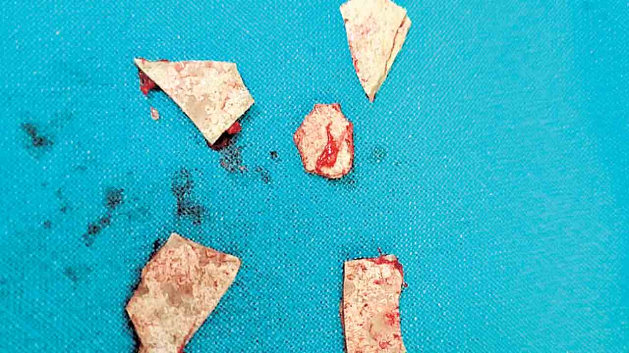 సంగారెడ్డి దవాఖానలో శస్త్ర చికిత్స