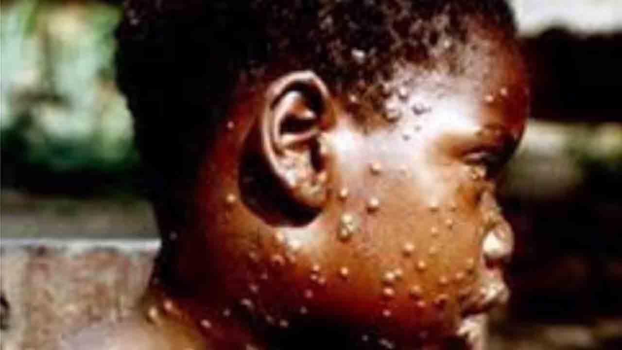 Monkeypox | డేంజర్‌ బెల్స్‌.. 27 దేశాలకు పాకిన వైరస్‌.. ఎన్ని కేసులు నమోదయ్యాయంటే..?