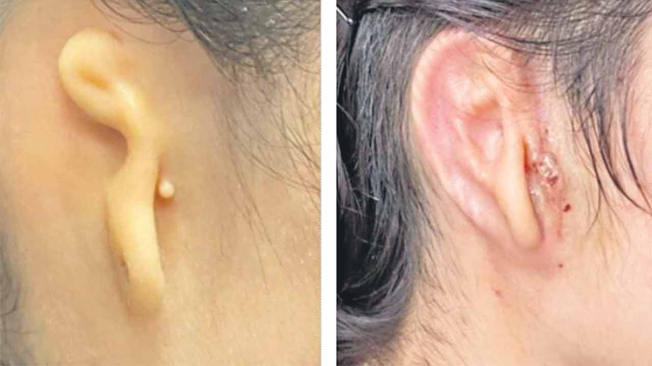 సజీవ కణాలతో 3డీ ప్రింటెడ్‌ చెవి ఇంప్లాంట్‌