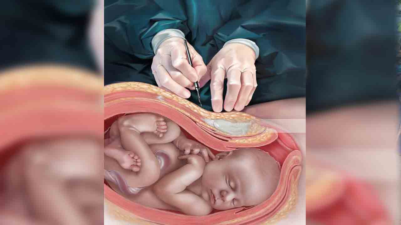 సిజేరియన్లపై నజర్‌