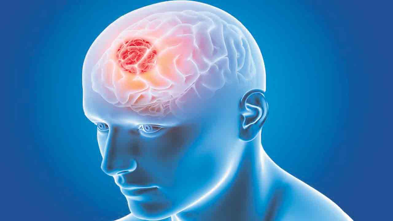 ప్రాణాంతకం.. మెదడులో కణుతులు