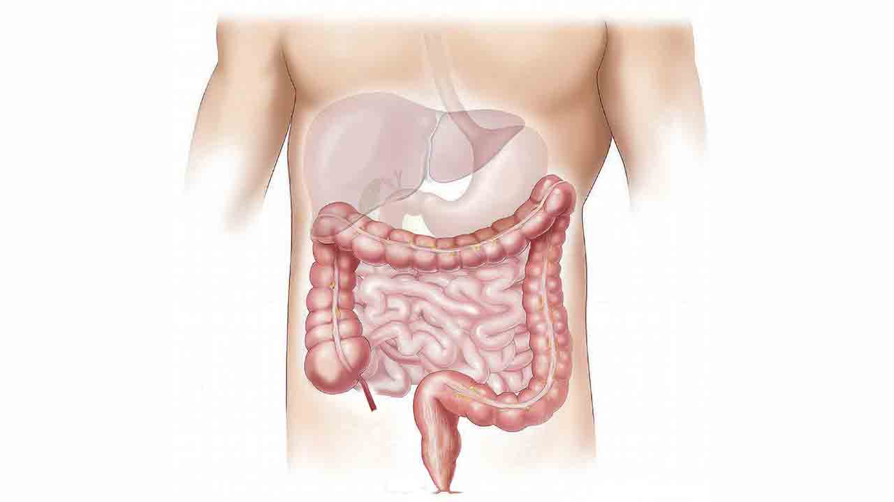 కోలన్‌ క్యాన్సర్‌ లక్షణాలు-చికిత్స