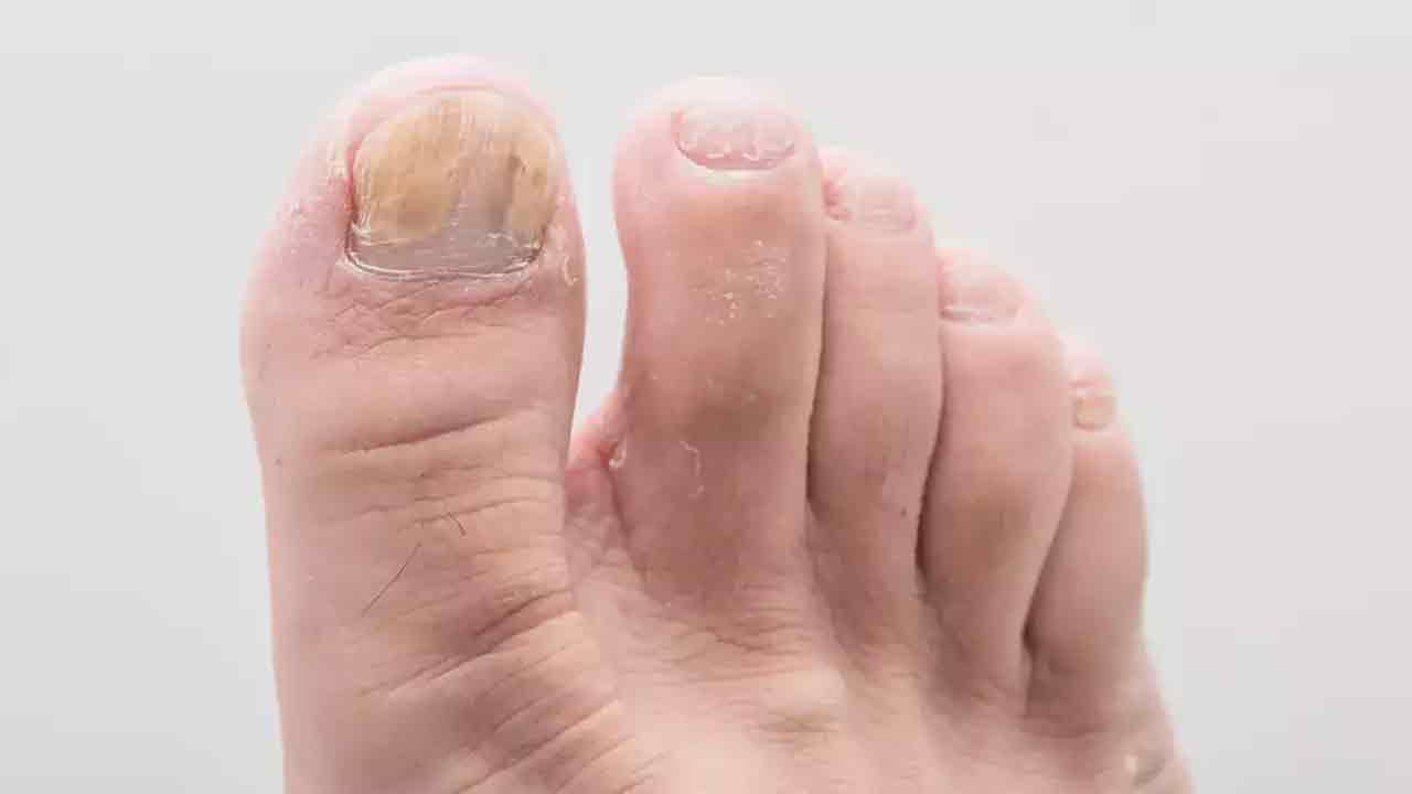 Toenails changing colour | కాలిగోళ్లు రంగు మారుతున్నాయా? జాగ్ర‌త్త‌.. ఇదే కార‌ణం కావొచ్చు?