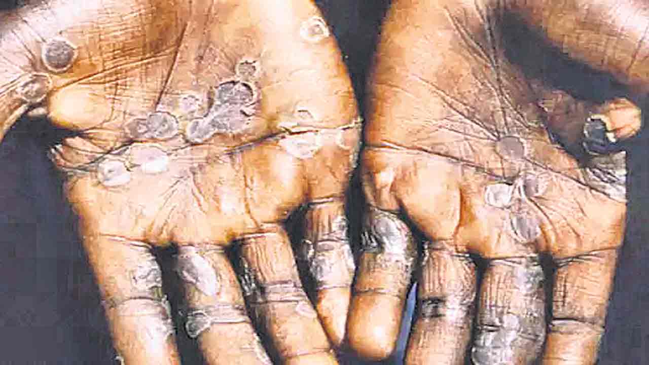 98% మంకీపాక్స్‌ రోగులు గేలే!