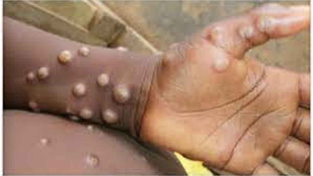 గుంటూరు జిల్లాలో మంకీపాక్స్ క‌ల‌క‌లం.. 8 ఏండ్ల బాలుడి ఒంటిపై ద‌ద్దుర్లు