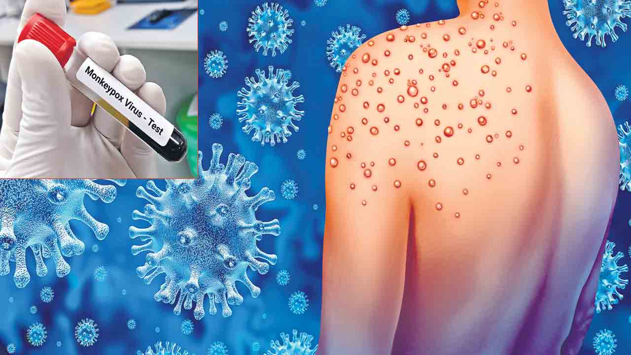 మరో ముప్పు.. మంకీపాక్స్‌!
