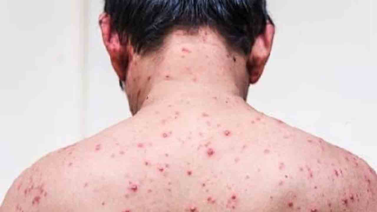 Monkeypox | మూడురెట్లు పెరిగిన మంకీపాక్స్‌ కేసులు.. కొత్త లక్షణాలపై నిపుణుల ఆందోళన!!