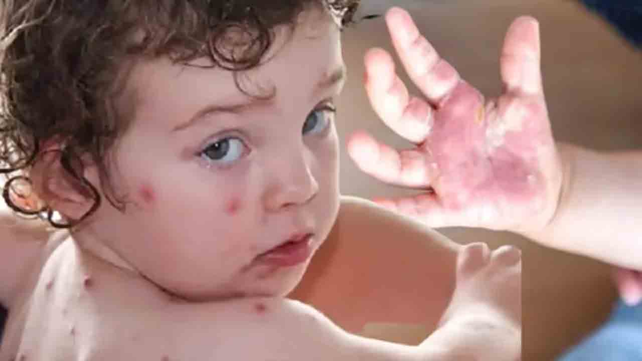 Tomato Fever | టొమాటో ఫీవర్‌తో పిల్లలకు ముప్పు..! లక్షణాలు, నివారణ చర్యలు ఇవే..!