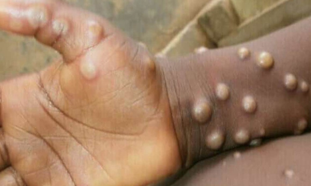 Monkeypox Symptoms: మంకీపాక్స్ ప్రాణాంతకమా? దాని లక్షణాలు ఏంటి?