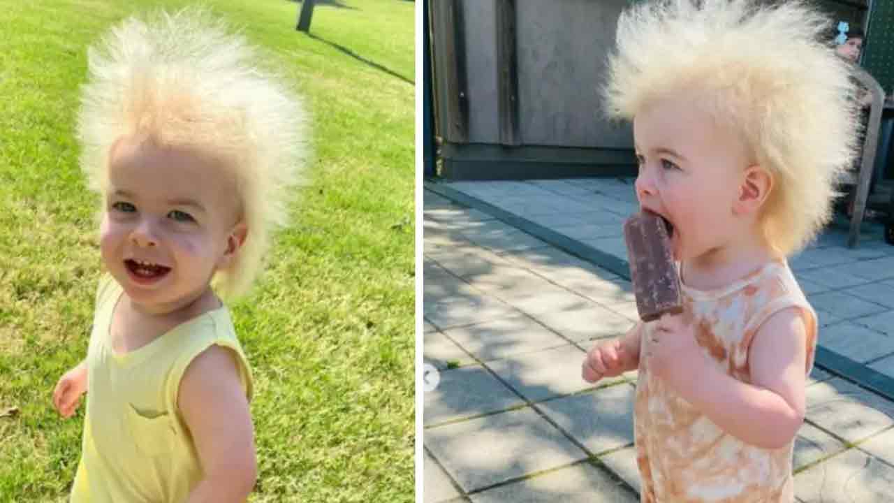 Uncombable Hair Syndrome | అరుదైన హెయిర్ సిండ్రోమ్‌.. ఆల్బ‌ర్ట్ ఐన్‌స్టీన్‌లా క‌నిపిస్తున్న చిన్నారి వీడియో వైర‌ల్‌!!