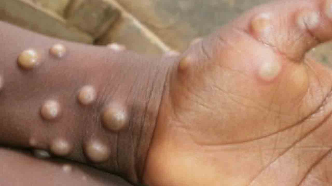 మంకీపాక్స్‌ పాతదే