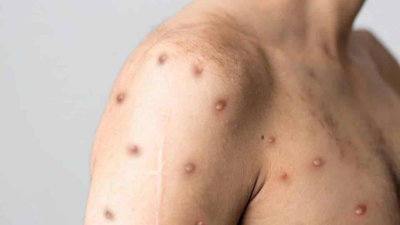 కామారెడ్డి జిల్లాలో మంకీపాక్స్‌ కలకలం