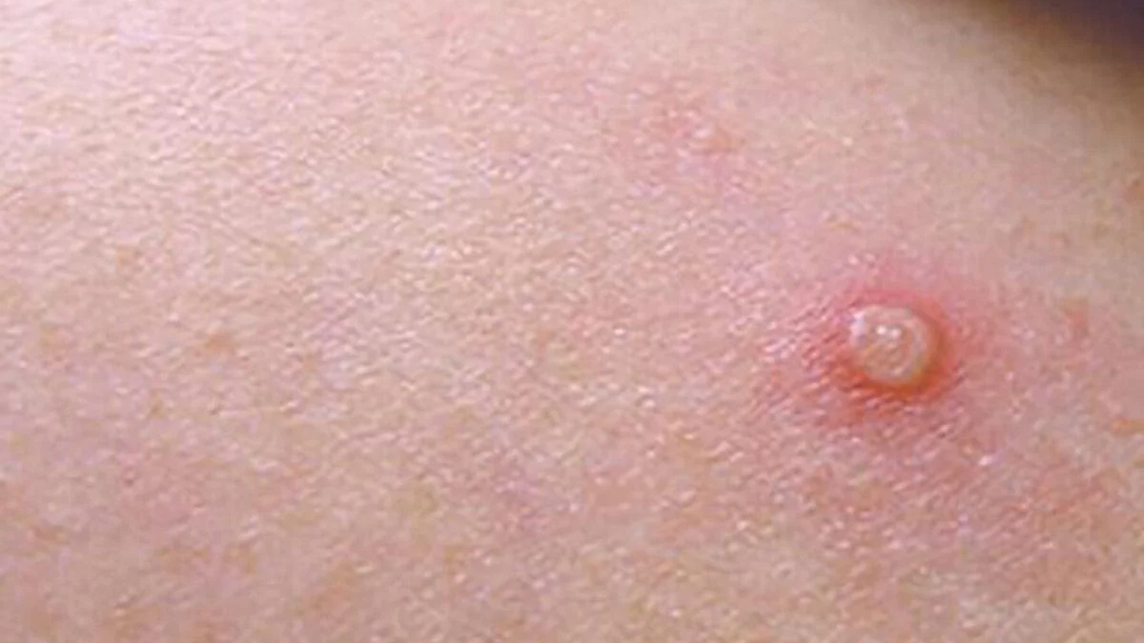 మంకీపాక్స్‌ పట్ల అప్రమత్తంగా ఉండండి.. రాష్ట్రాల‌కు కేంద్రం సూచ‌న‌