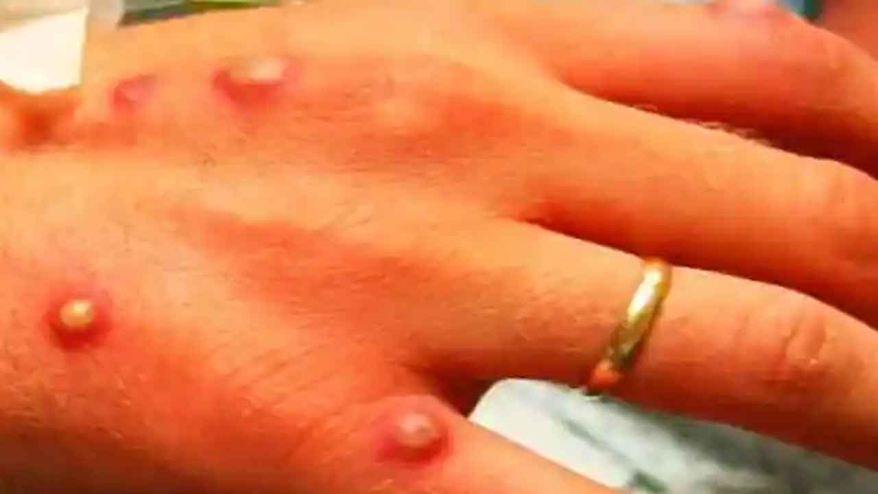 విశాఖలో మంకీపాక్స్‌ కలకలం..