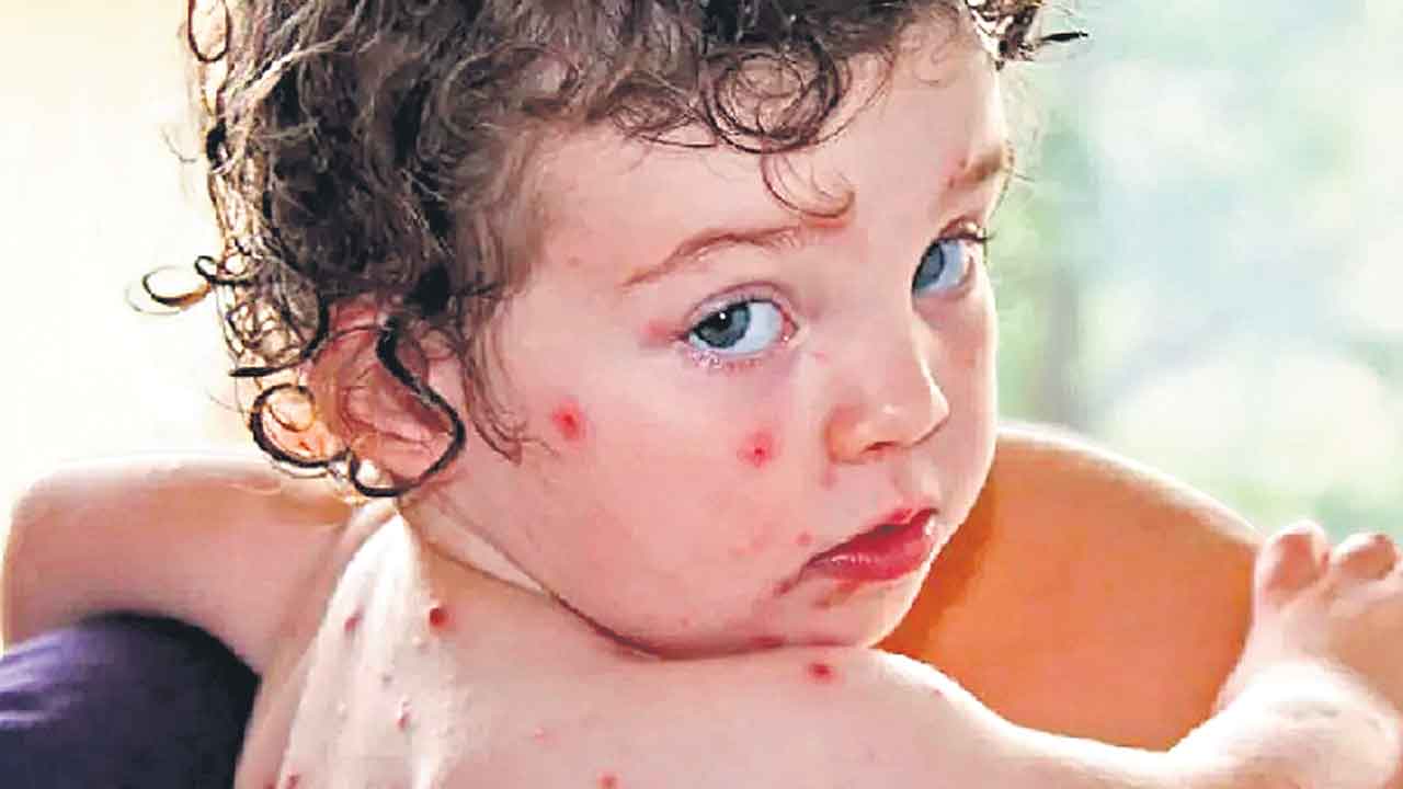 టమాట ఫ్లూ.. భయం వద్దు