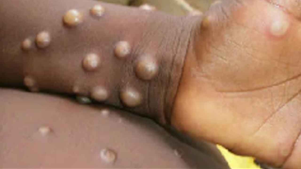 అమెరికాలో హెల్త్‌ ఎమర్జెన్సీ