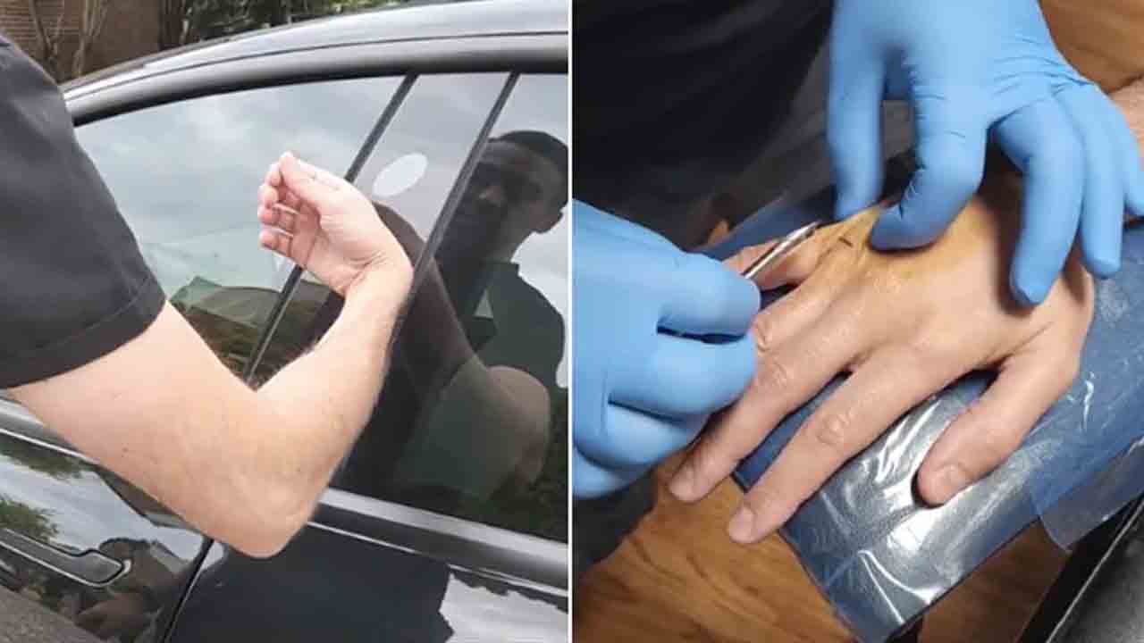 కారును అన్‌లాక్‌ చేయడానికి చేతిలో చిప్ పెట్టించుకున్నాడు!