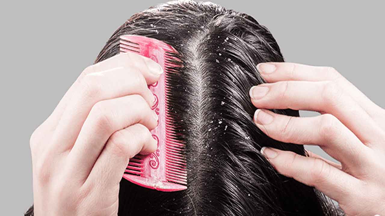 Dandruff | డాండ్రఫ్‌ బాధపెడుతోందా..? ఈ చిట్కాలు పాటించండి!