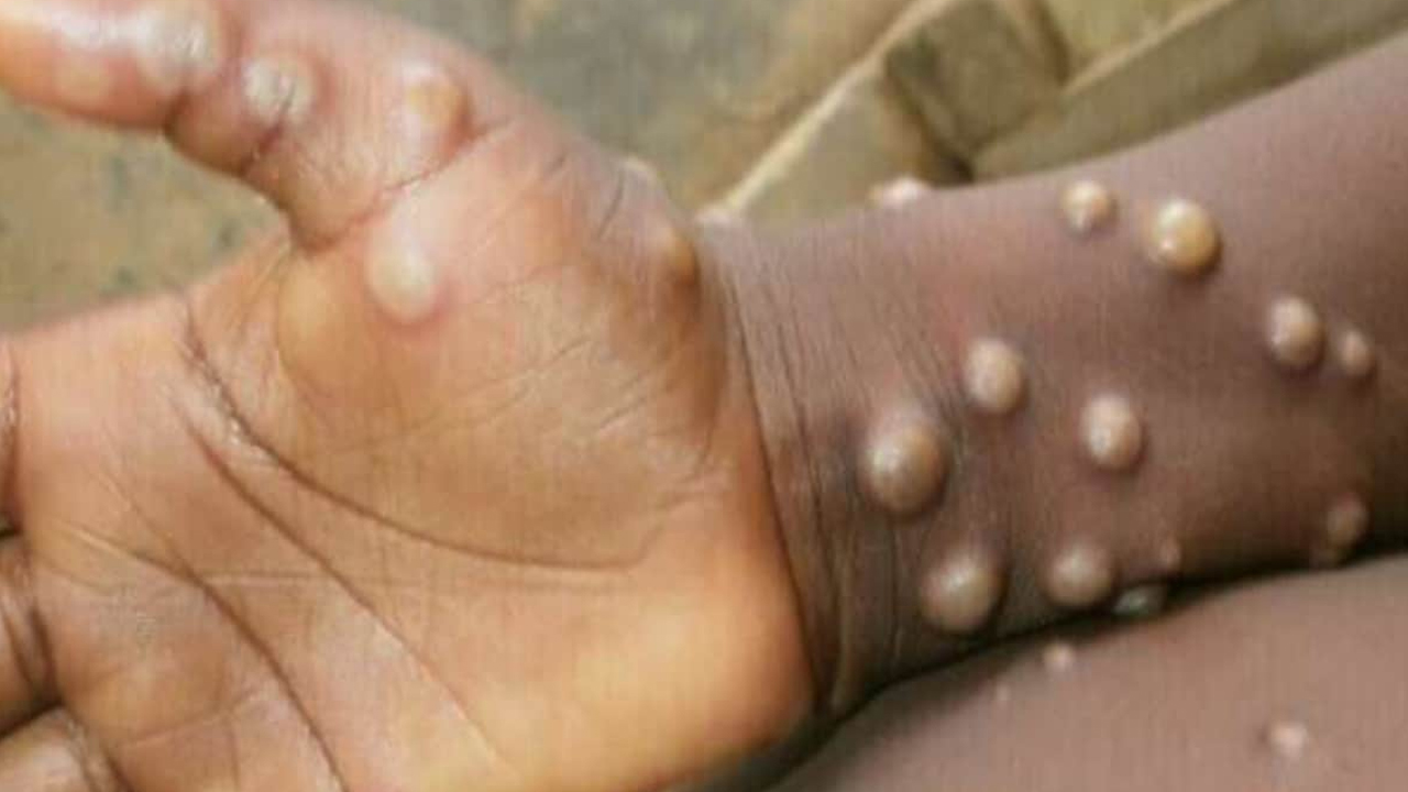 Monkeypox | 35 వేలు దాటిన మంకీపాక్స్ కేసులు.. 12 మంది మృతి: డ‌బ్ల్యూహెచ్‌వో ఆందోళ‌న‌