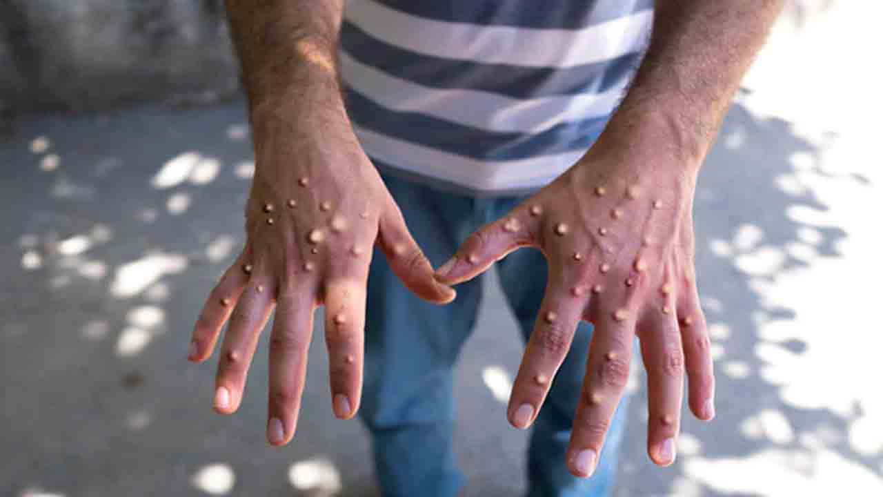 మృతుడికి మంకీపాక్స్‌ పాజిటివ్‌..! 20 మంది క్వారంటైన్‌కు తరలింపు..!!