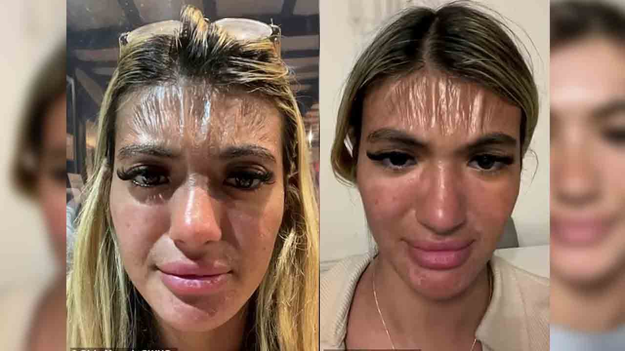 Shocking | ఎండలో పడుకుంటే.. ఆ అమ్మాయి నుదుటి చర్మం ప్లాస్టిక్‌లా మారిపోయింది!