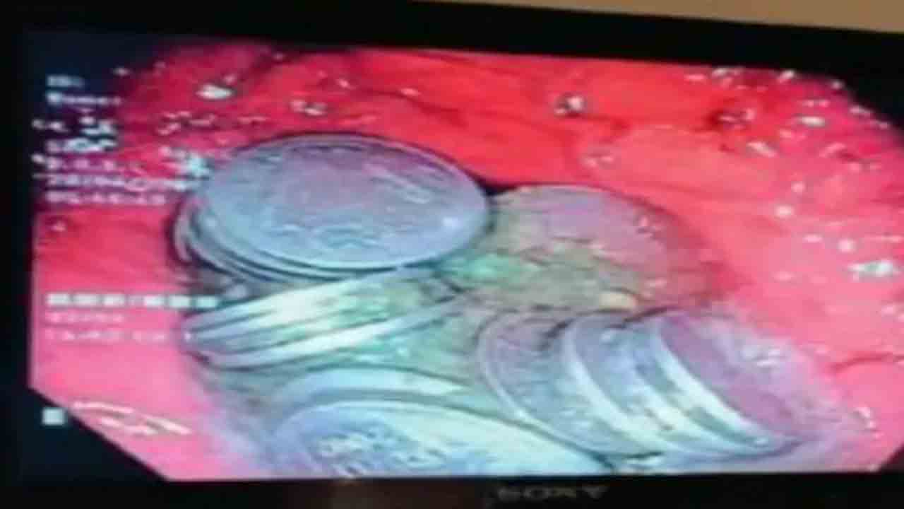 63 రూపాయి నాణేలు మింగిన వ్యక్తి… రెండు రోజులు ఆపరేషన్‌ చేసి తొలగించిన వైద్యులు