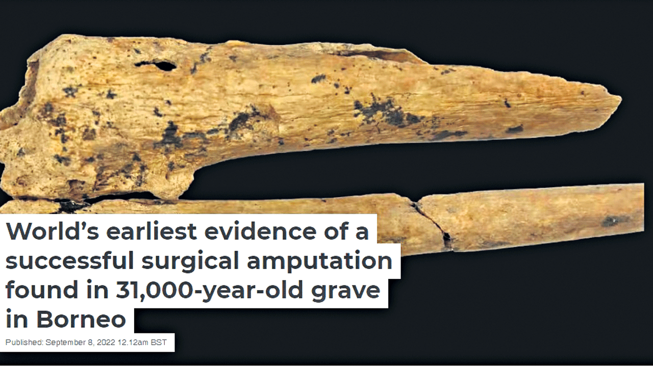 31 వేల ఏండ్ల కిందటే అవయవ తొలగింపు చికిత్స