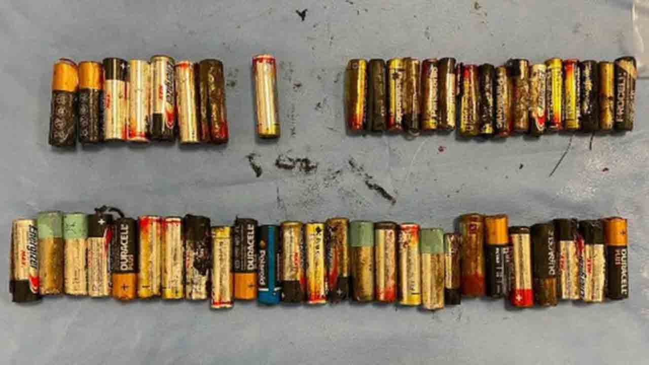 55 బ్యాటరీలు మింగిన మహిళ… ఆపరేషన్‌ చేసి తొలగించిన వైద్యులు