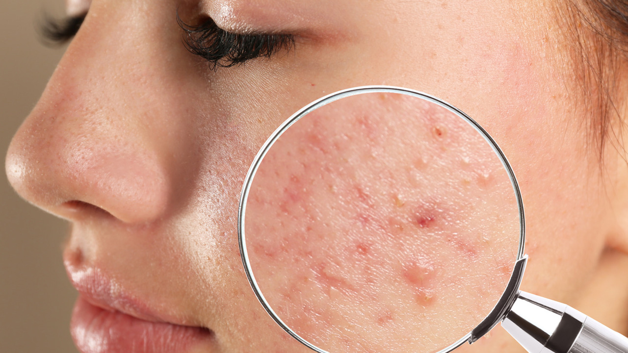 Pimples | మొటిమలు రాకుండా చేసుకోవడం ఈజీ.. ఎలాగంటే..?