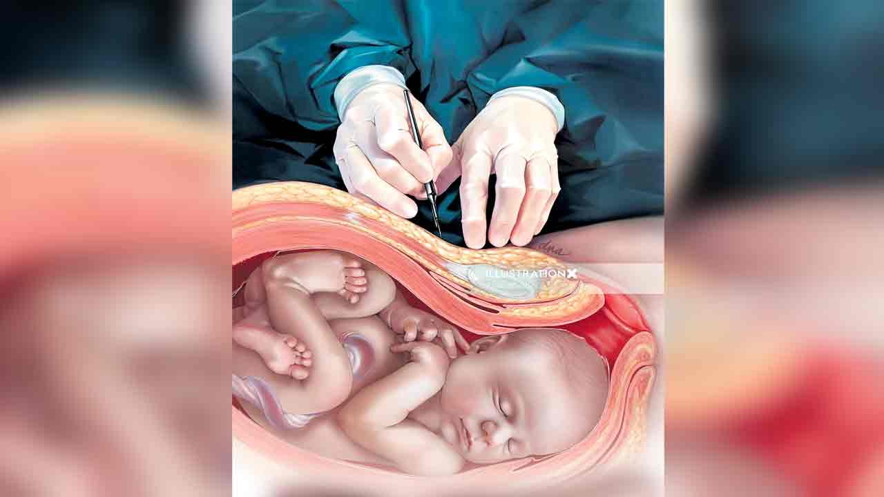 ‘ప్రైవేటు’లో ఆగని‘కడుపు కోతలు’