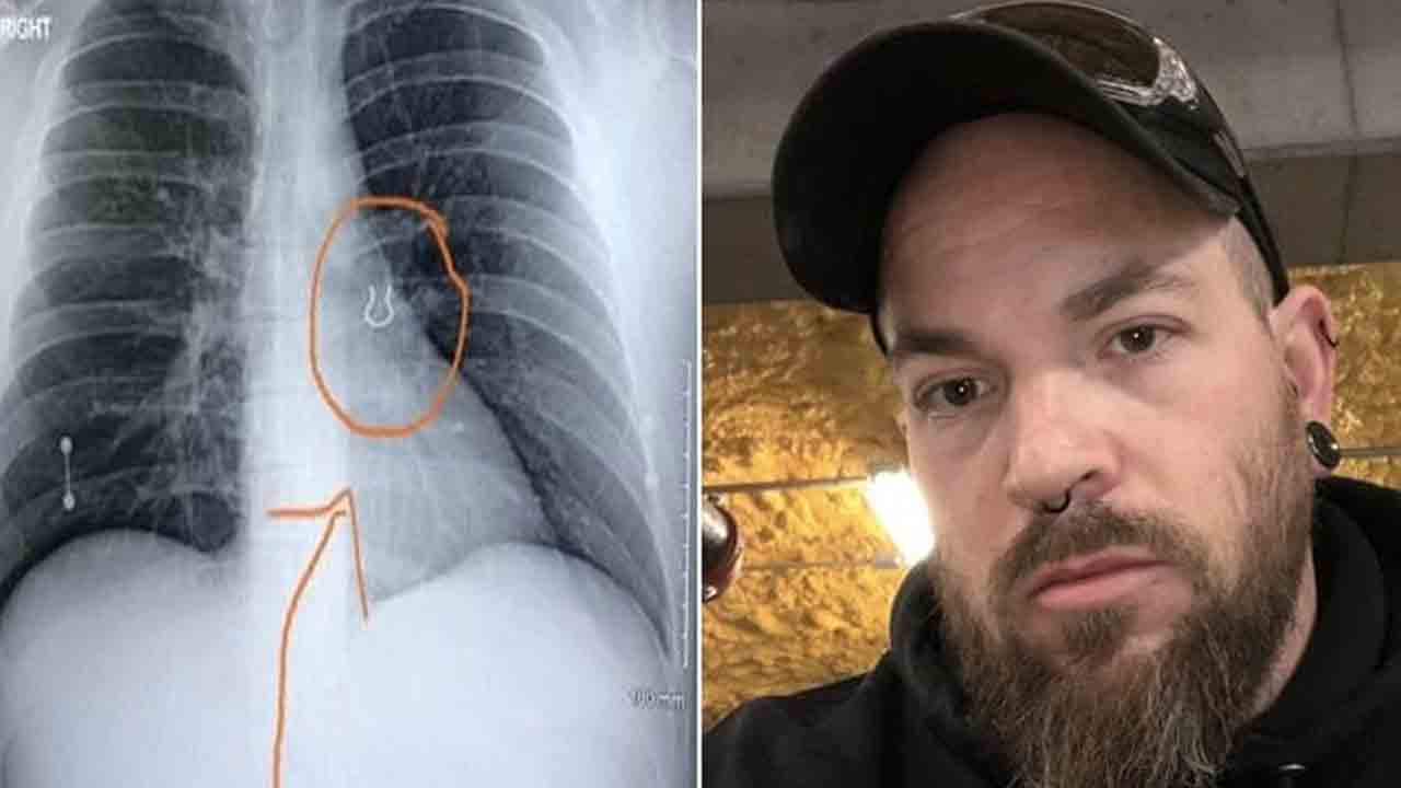 ఐదేళ్ల కిందట నోస్‌ రింగ్‌ కోల్పోయిన వ్యక్తి… ఊపిరితిత్తుల్లో కనుగొన్న డాక్టర్లు