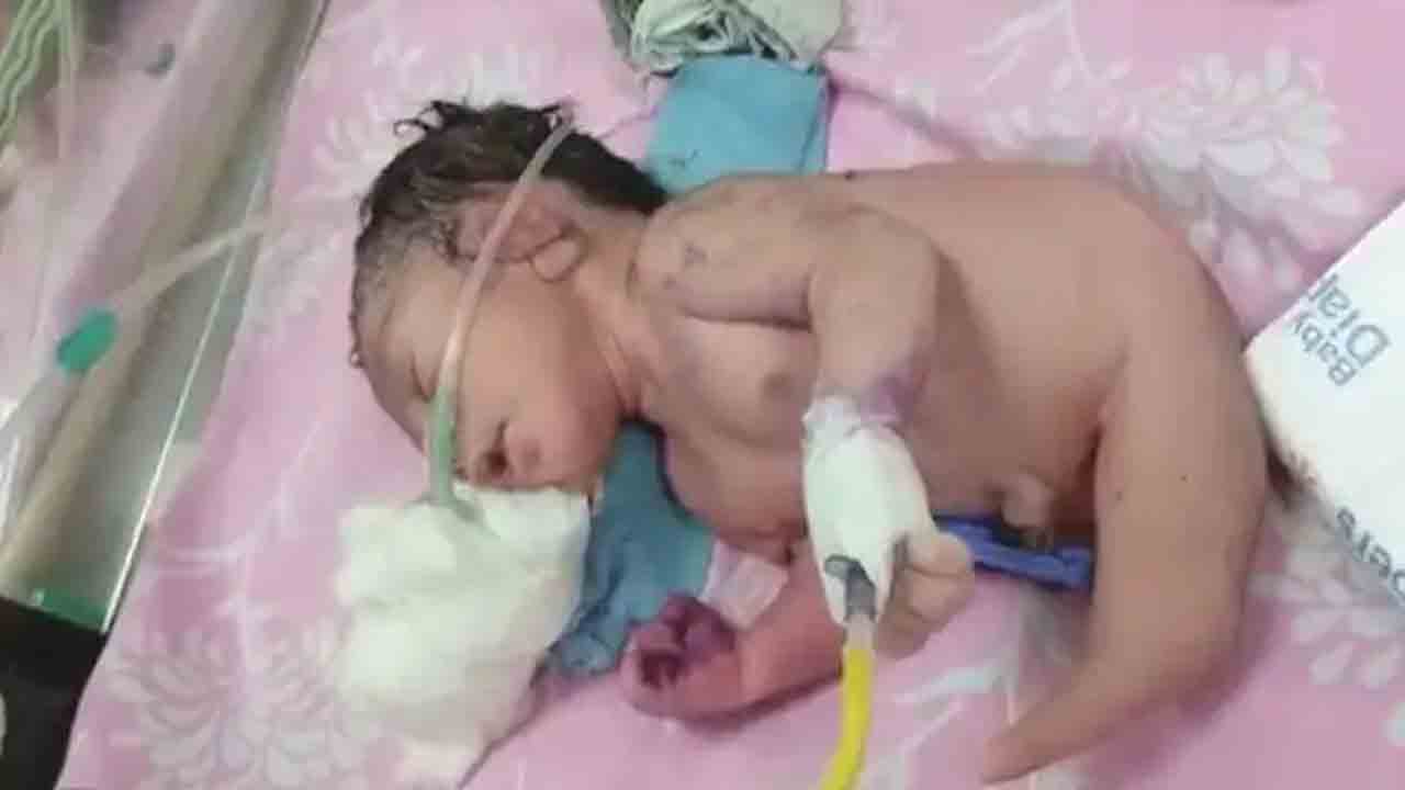 Rare case of birth defect: మ‌ధ్య‌ప్ర‌దేశ్‌లో వింత శిశువు.. డాక్ట‌ర్లే ఆశ్చ‌ర్య‌పోయారు!! ఈ లోపాల‌కు కార‌ణ‌మేంటంటే?