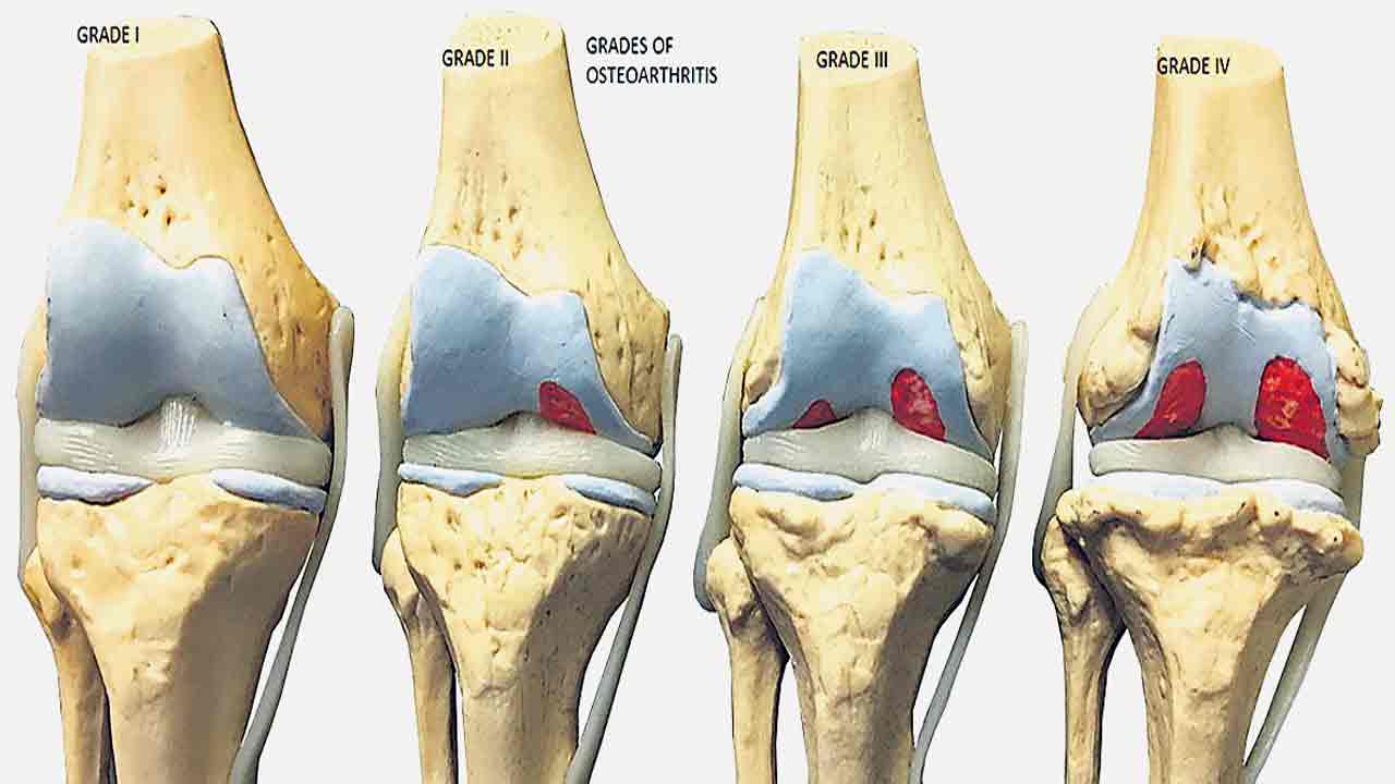 మోకాళ్ల నొప్పులకు చిన్న సూదితో పరిష్కారం!