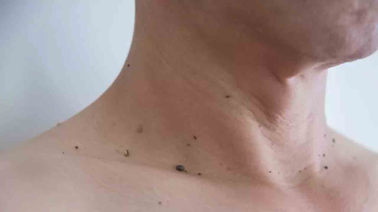 Health Tips | ఈ ఐదు స‌హ‌జ ప‌ద్ధ‌తులు పాటిస్తే పులిపిర్లు వాటంత‌ట అవే రాలిపోతాయి!