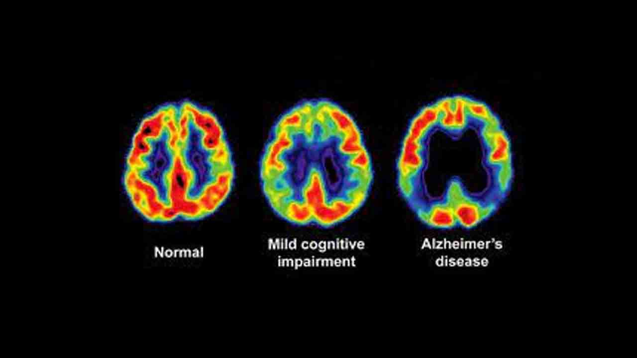 అల్జీమర్స్‌ను గుర్తించే ‘పీఈటీ’ స్కాన్‌