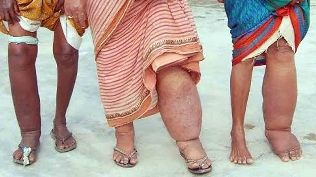 ‘బోద’ బాధకు ఉపశమనం