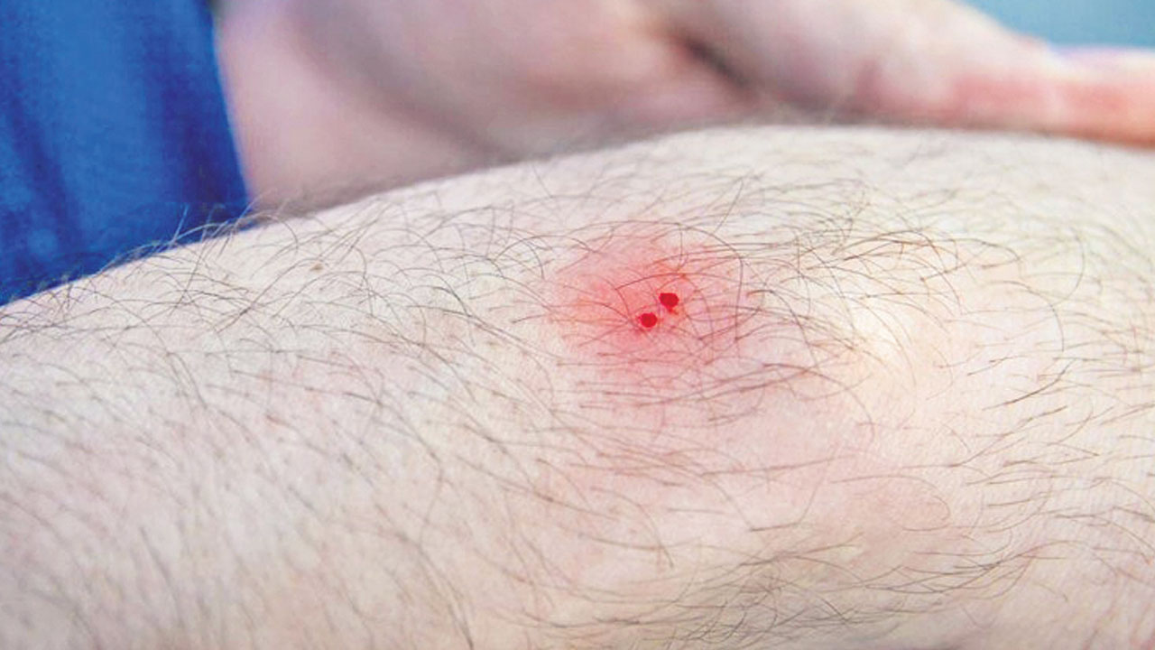 80% పాముకాటు మరణాలు భారత్‌లోనే!